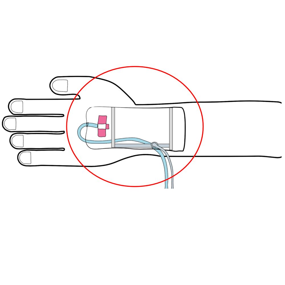 Illustration of a hand with an IV and dressing